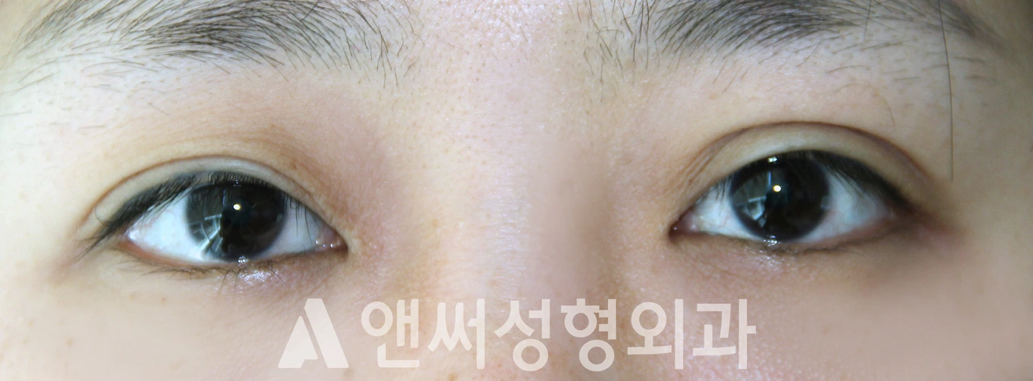 Answer Plastic Surgery case 622: Before