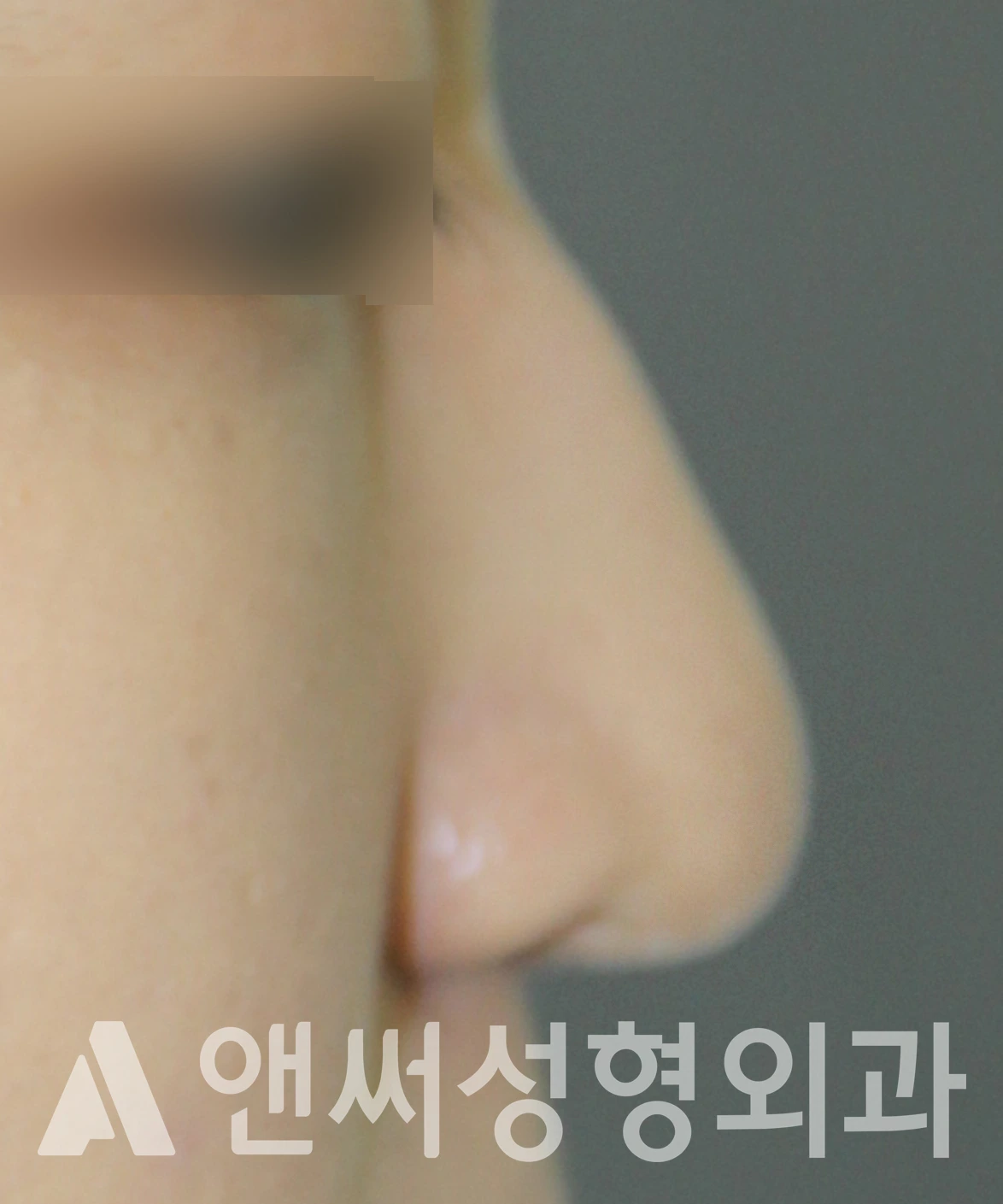 Answer Plastic Surgery case 621: Before