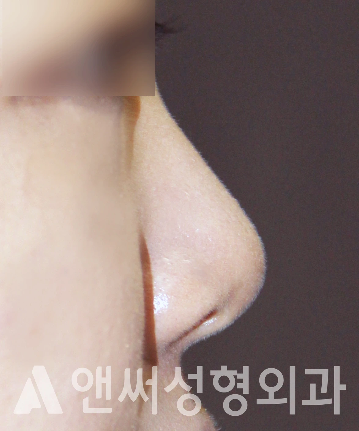 Answer Plastic Surgery case 620: Before