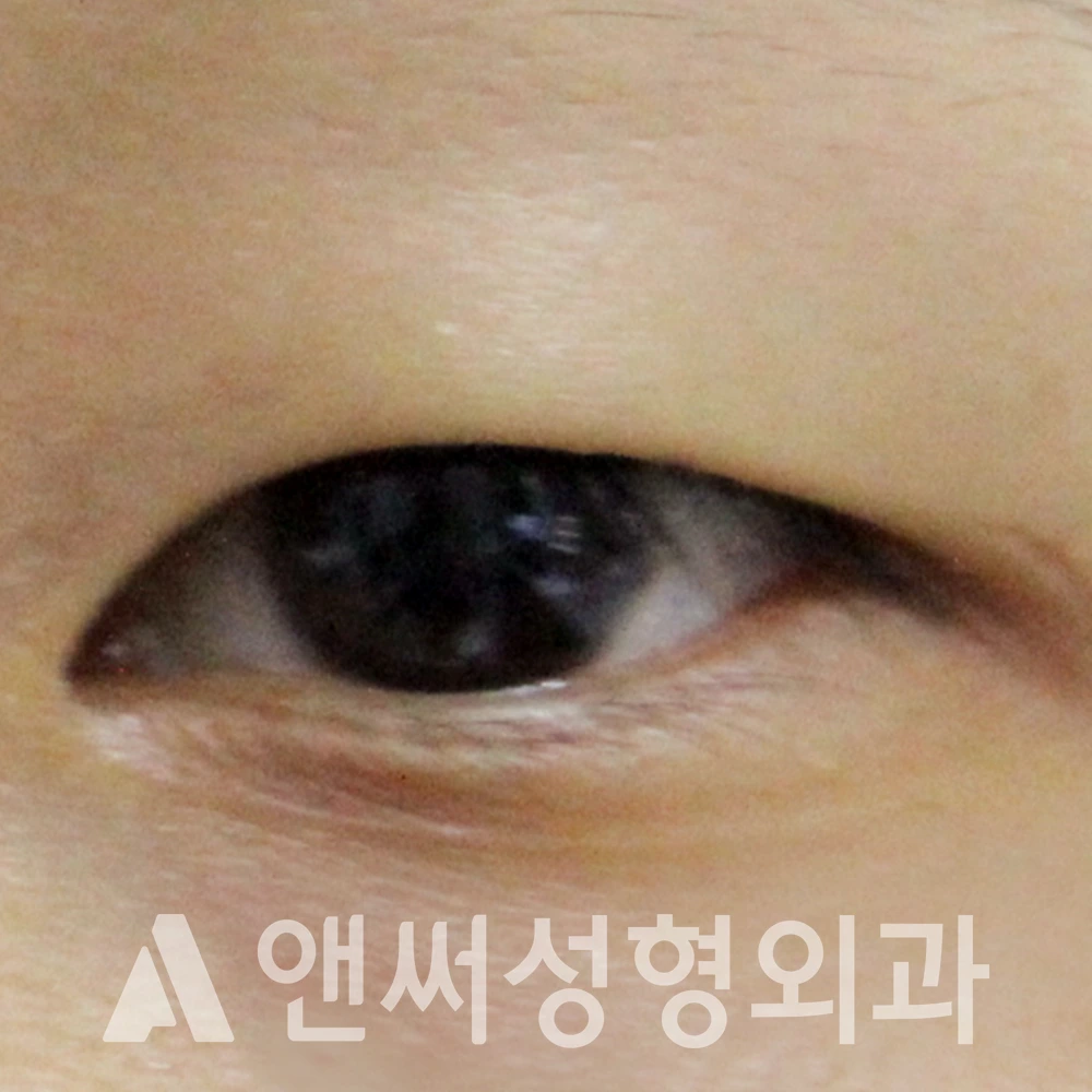Answer Plastic Surgery case 619: Before