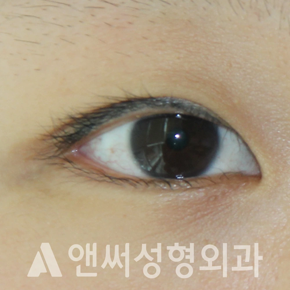 Answer Plastic Surgery case 618: Before