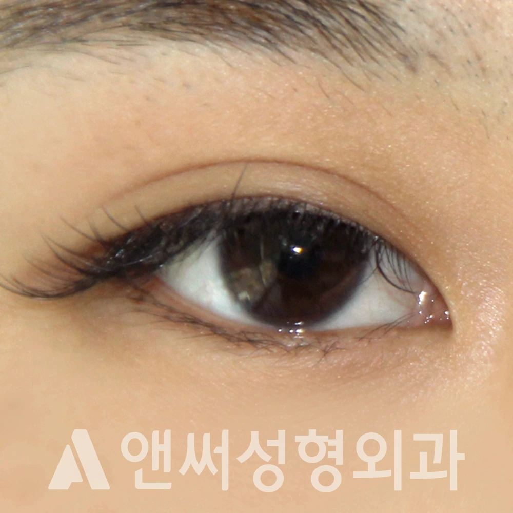 Answer Plastic Surgery case 617: Before