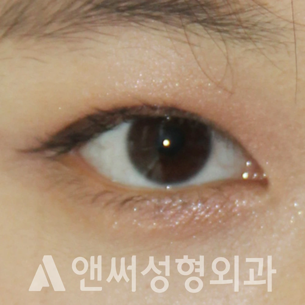 Answer Plastic Surgery case 616: Before