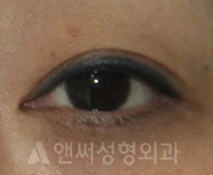 Answer Plastic Surgery case 615: Before