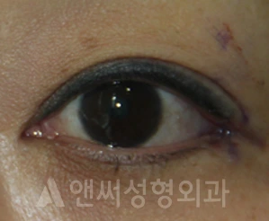 Answer Plastic Surgery case 615: After