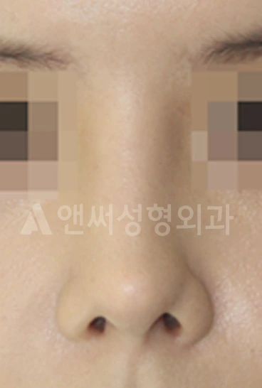 Answer Plastic Surgery case 614: Before