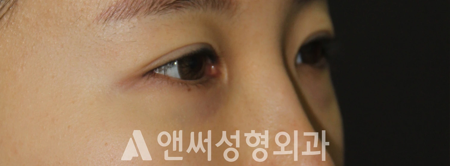 Answer Plastic Surgery case 613: Before