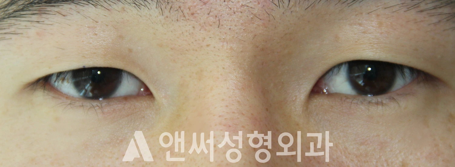 Answer Plastic Surgery case 612: Before
