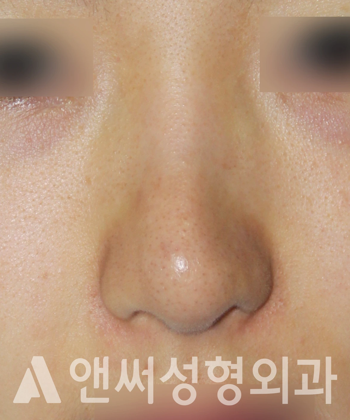 Answer Plastic Surgery case 611: Before