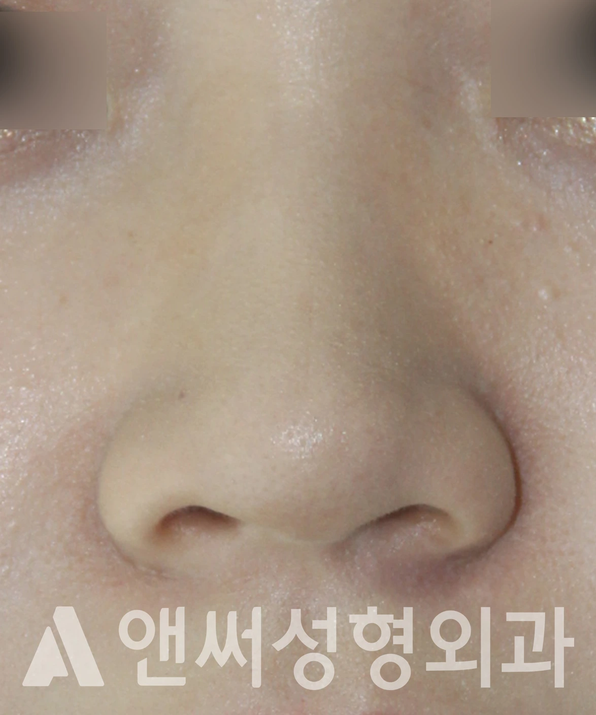 Answer Plastic Surgery case 603: Before
