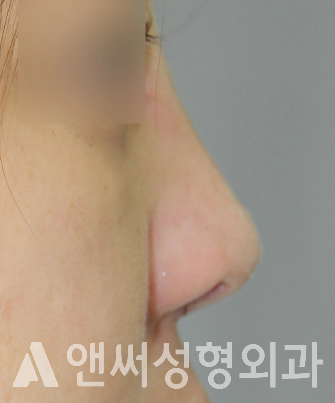 Answer Plastic Surgery case 602: Before