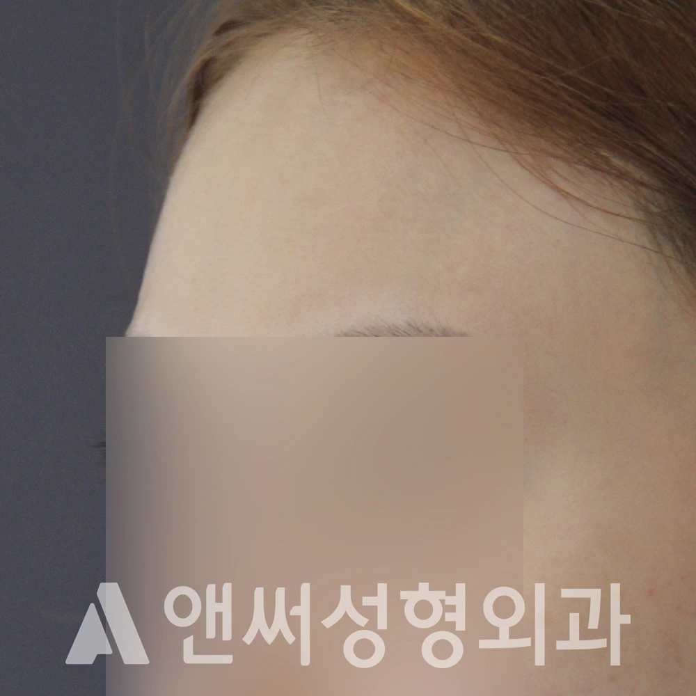 Answer Plastic Surgery case 600: Before