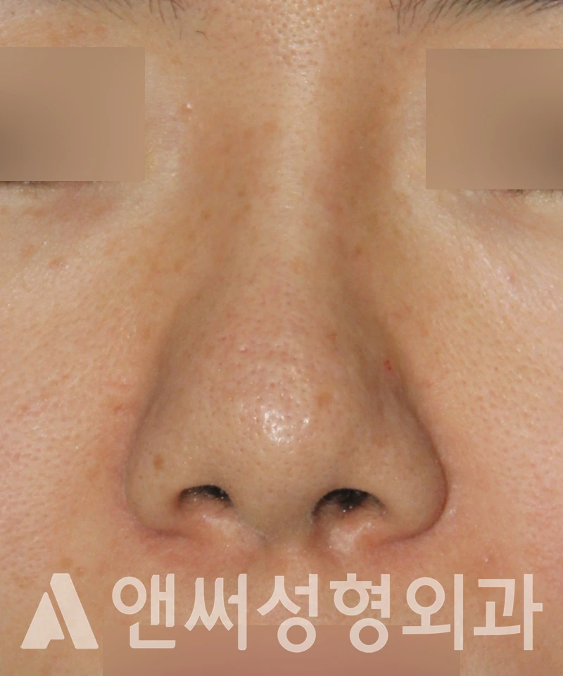 Answer Plastic Surgery case 599: Before