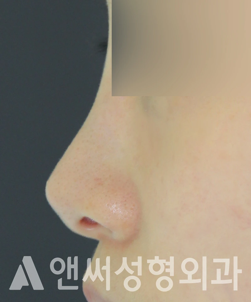 Answer Plastic Surgery case 598: Before