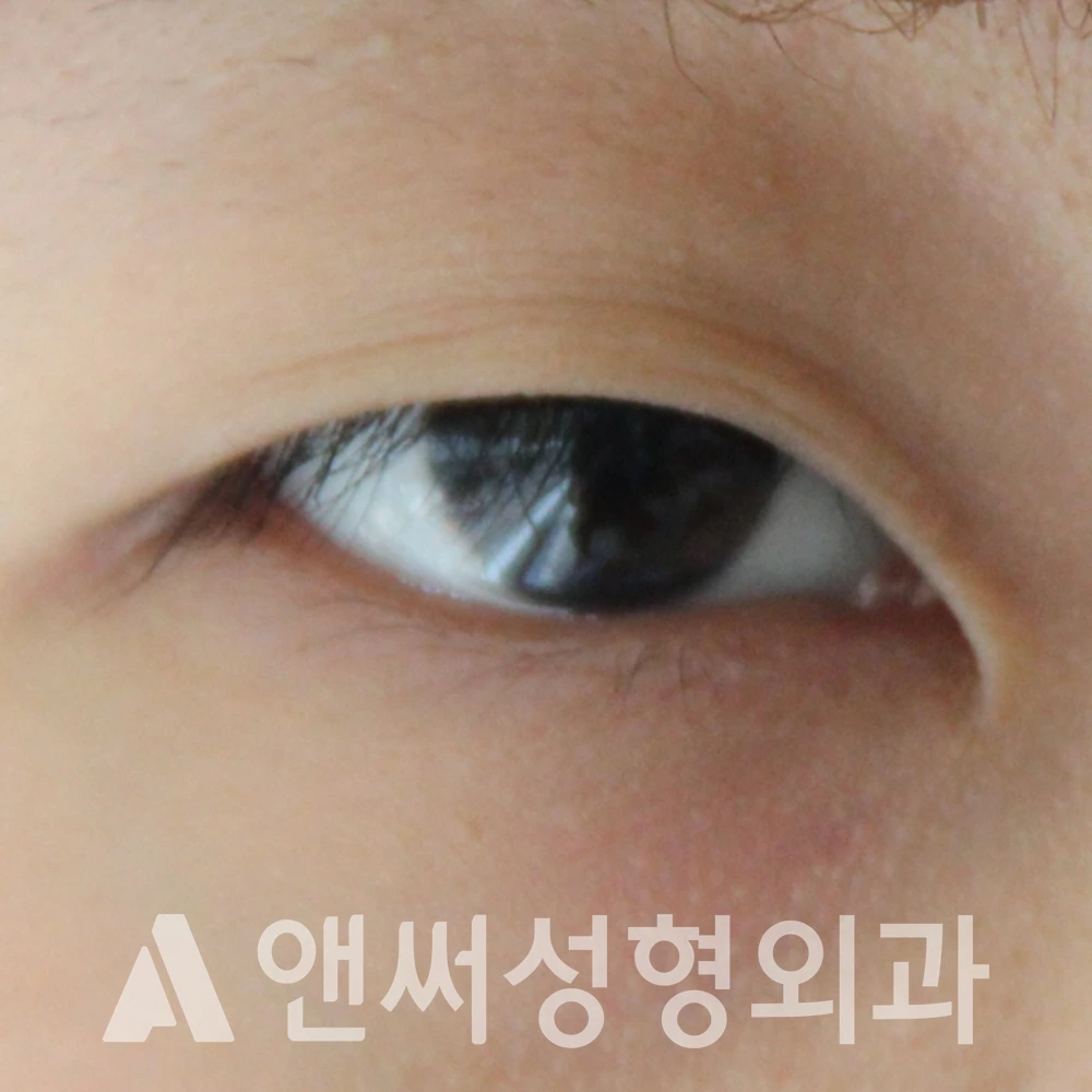 Answer Plastic Surgery case 597: Before