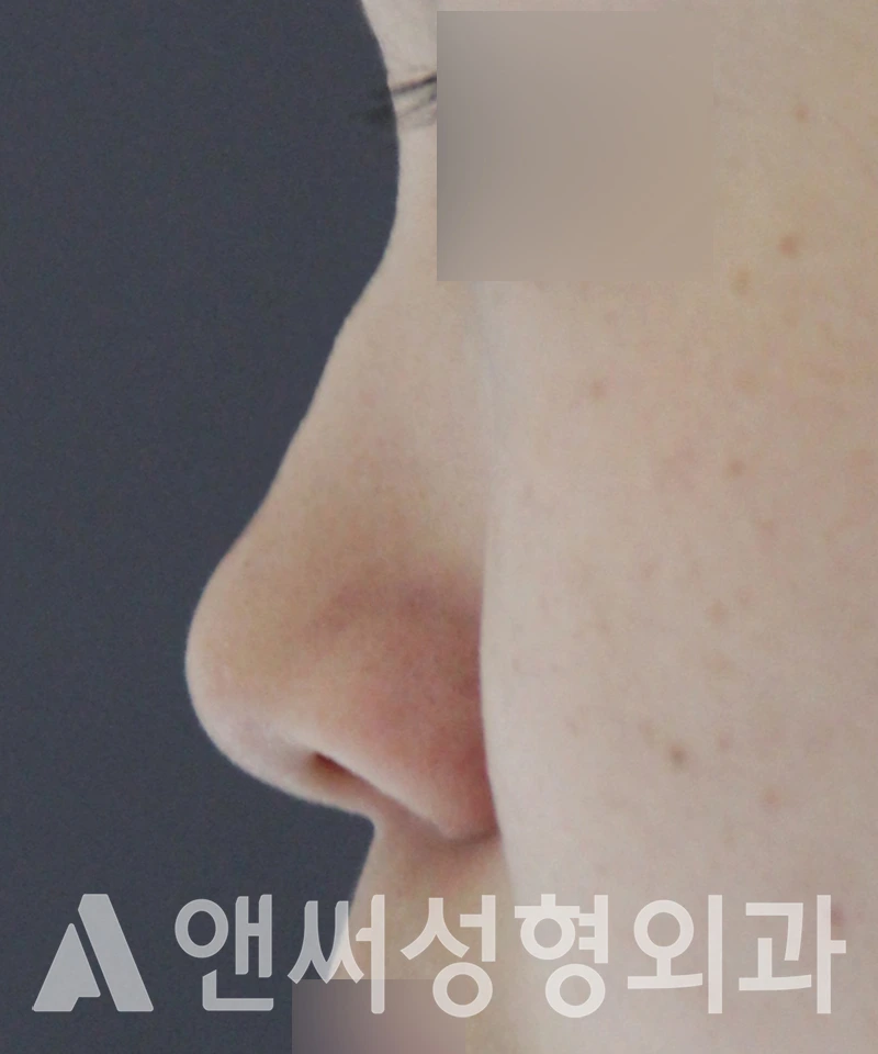 Answer Plastic Surgery case 591: Before