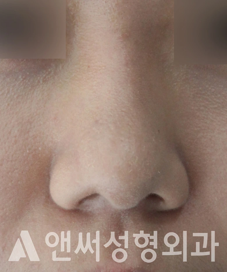 Answer Plastic Surgery case 590: Before