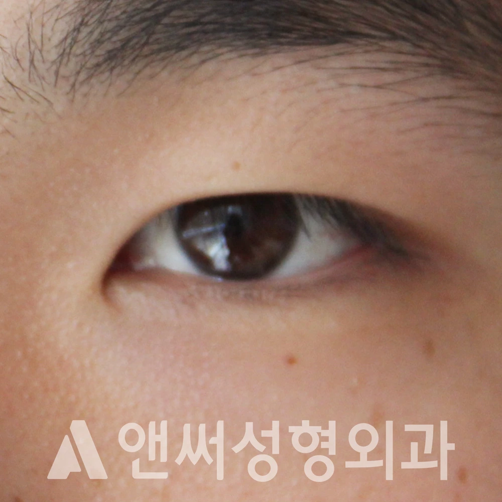 Answer Plastic Surgery case 588: Before