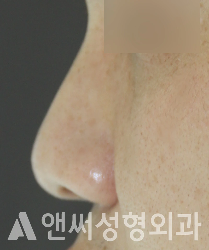 Answer Plastic Surgery case 587: Before