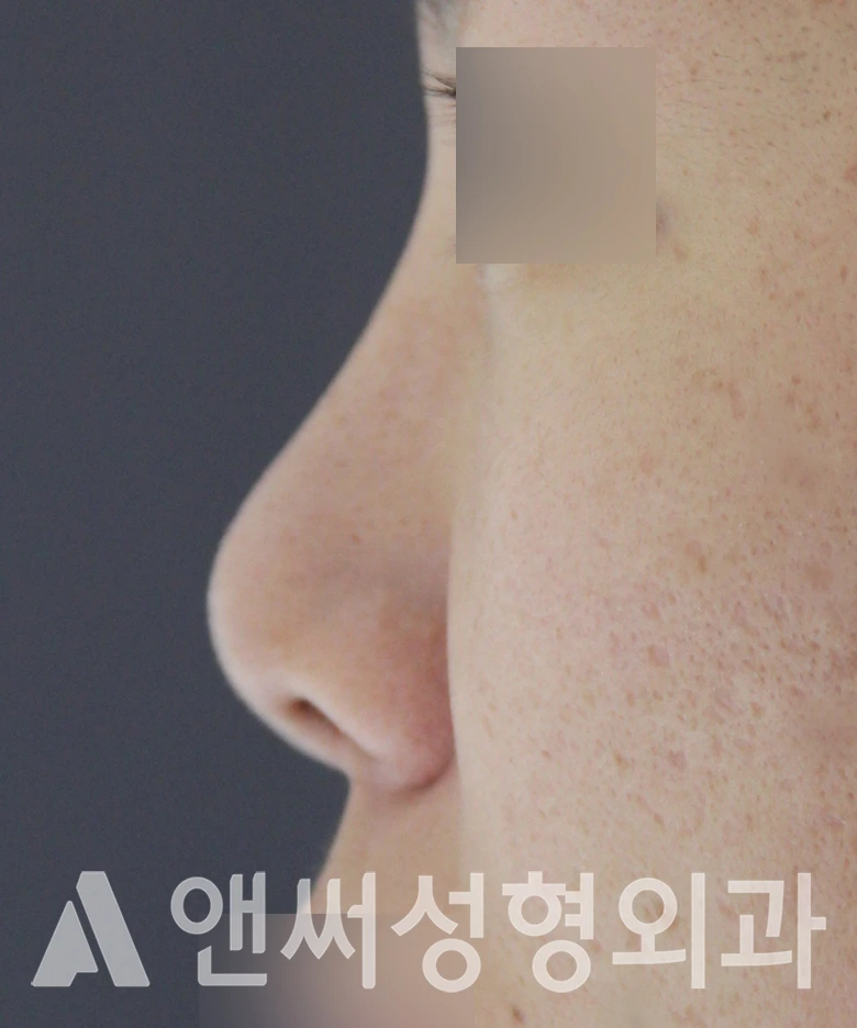 Answer Plastic Surgery case 585: Before
