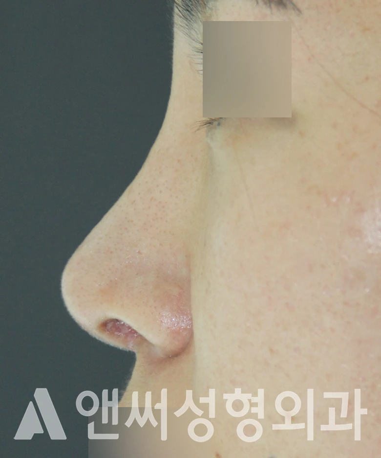 Answer Plastic Surgery case 585: After