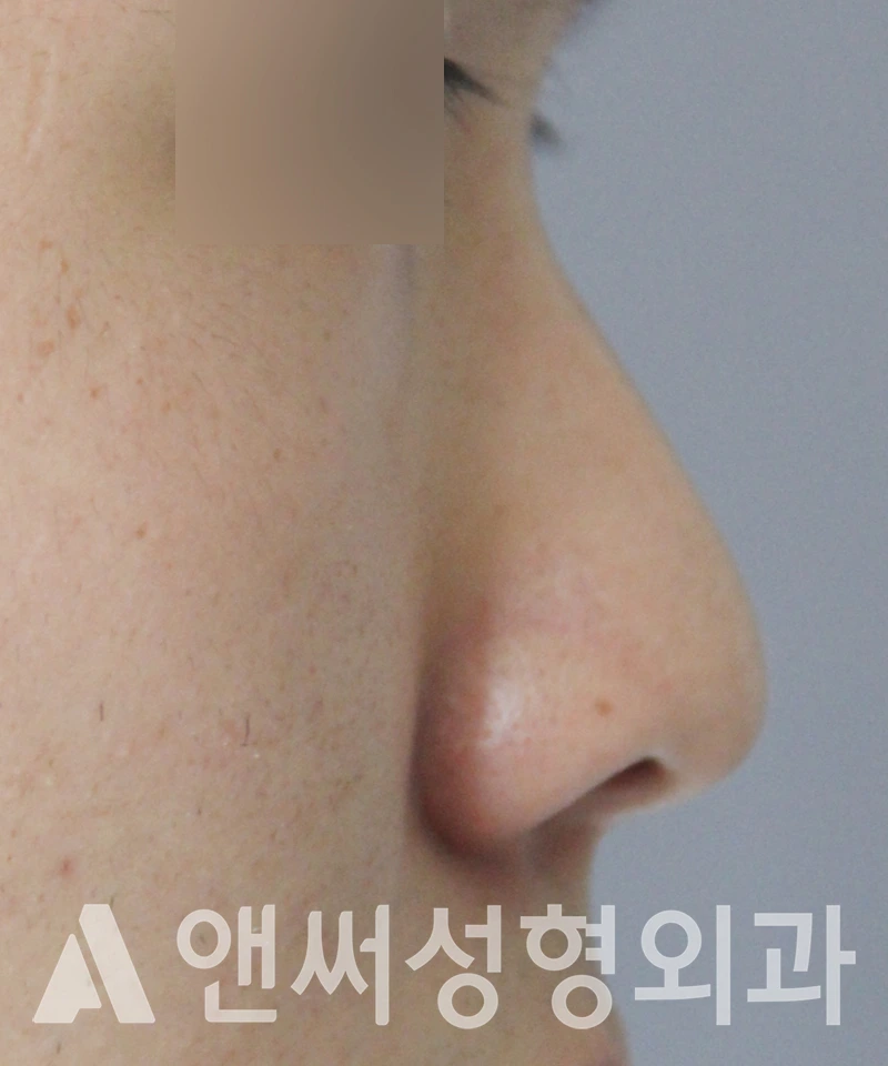 Answer Plastic Surgery case 584: Before