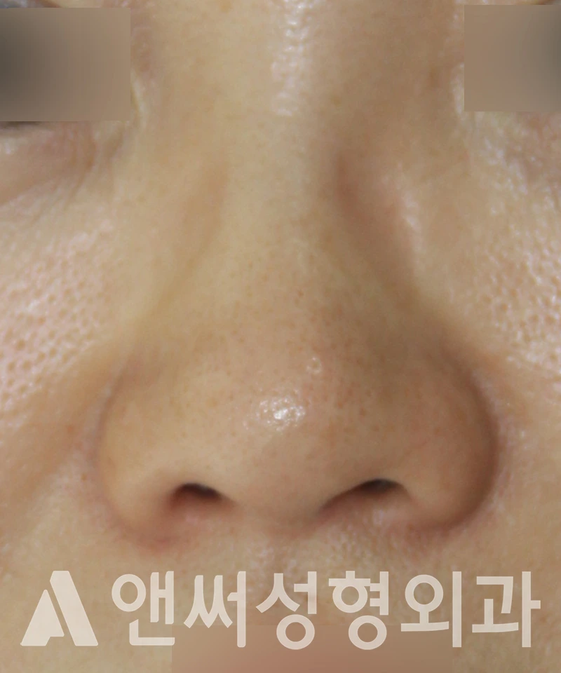Answer Plastic Surgery case 583: Before