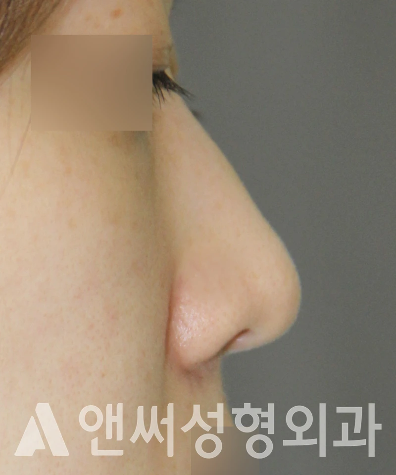 Answer Plastic Surgery case 581: Before