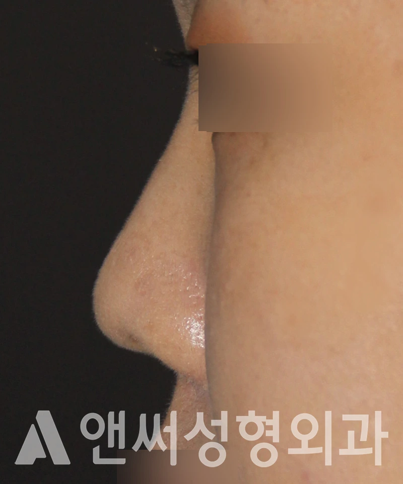 Answer Plastic Surgery case 577: Before