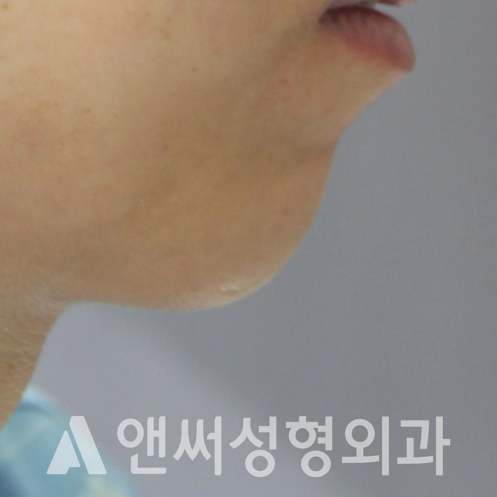 Answer Plastic Surgery case 552: Before