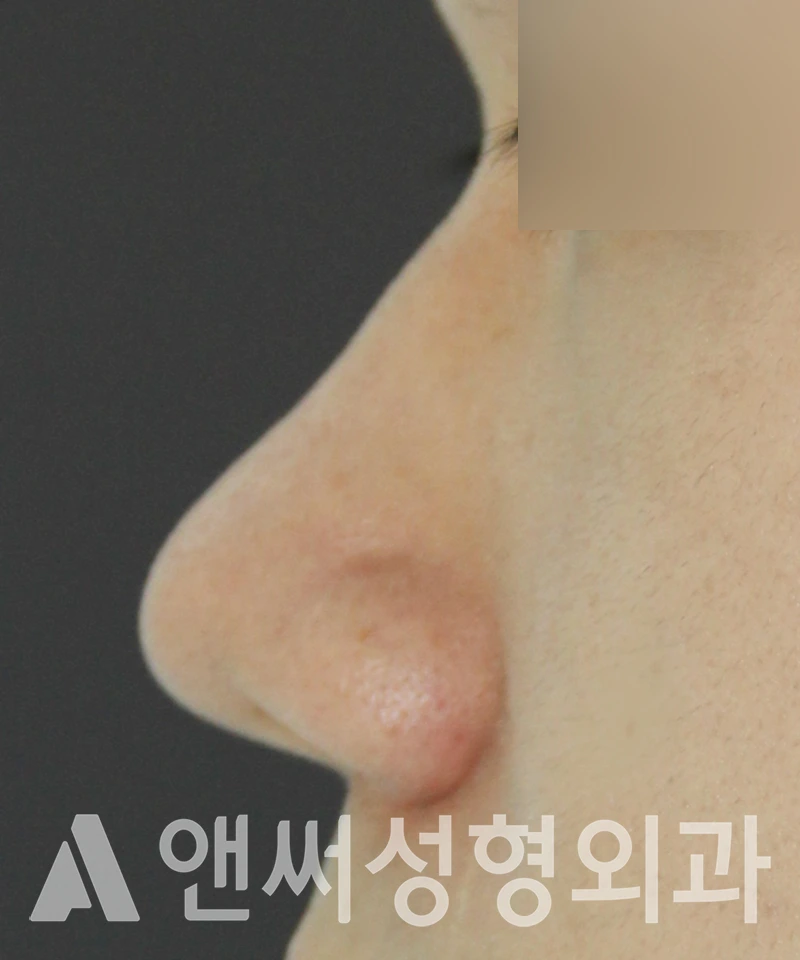 Answer Plastic Surgery case 550: Before
