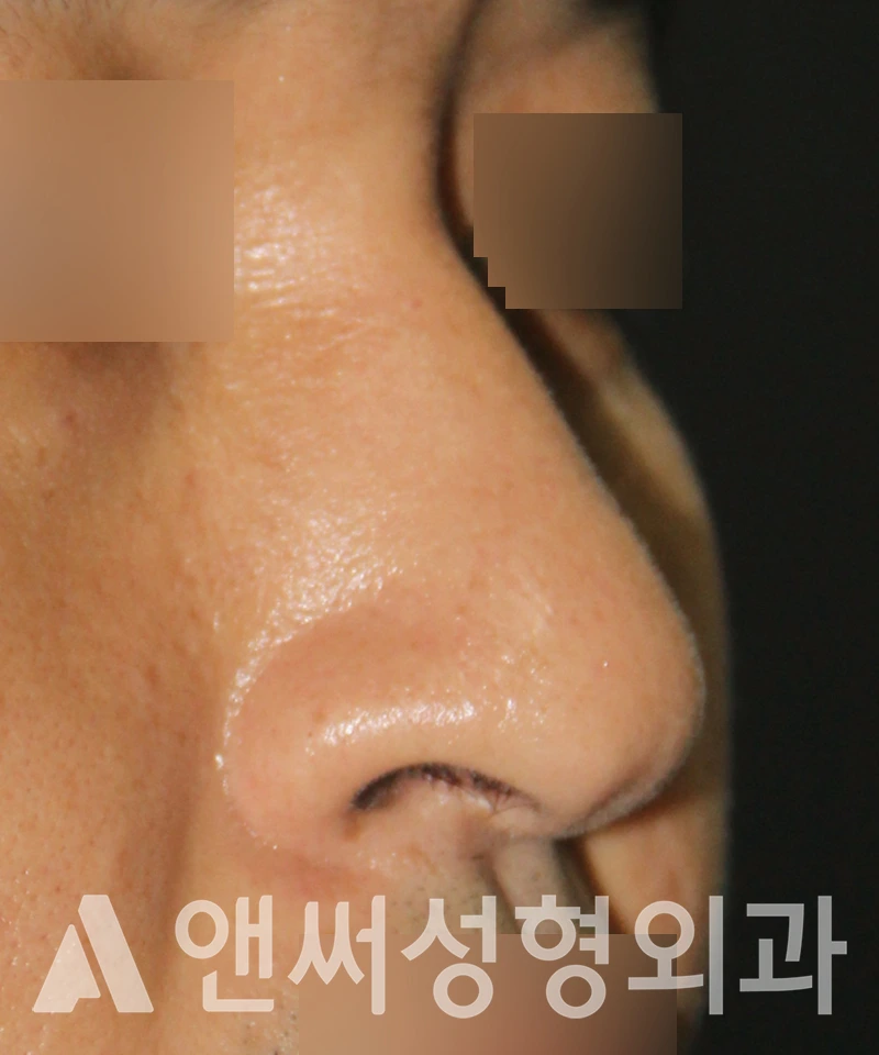 Answer Plastic Surgery case 547: Before