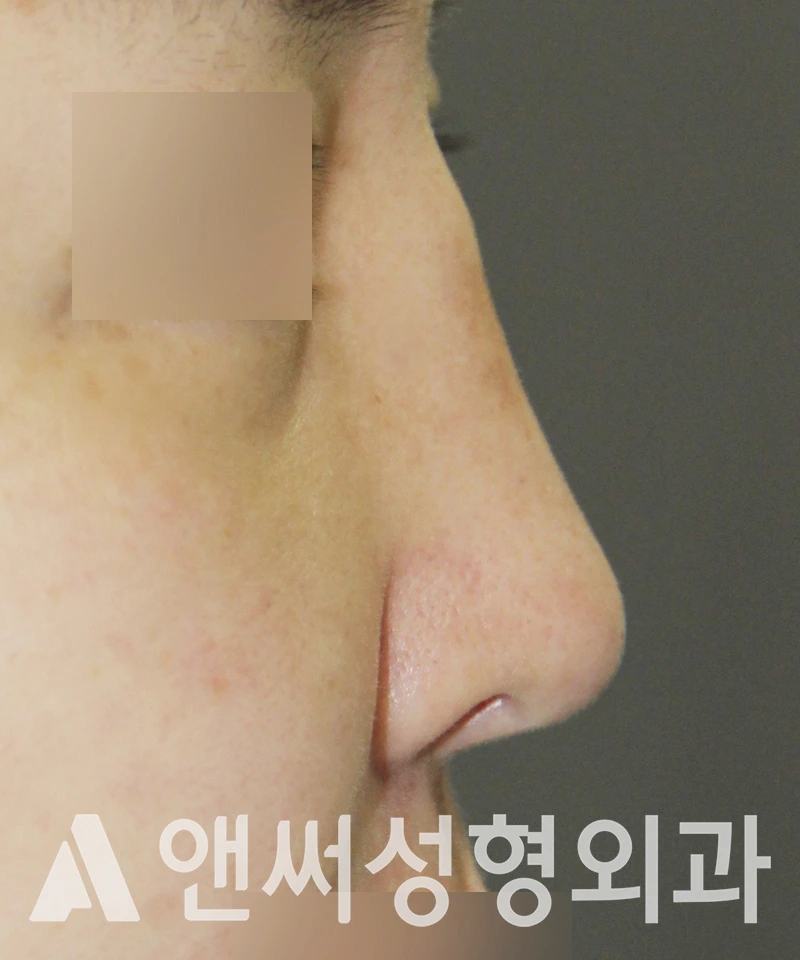Answer Plastic Surgery case 546: Before