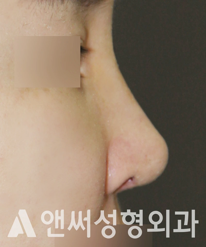 Answer Plastic Surgery case 546: After