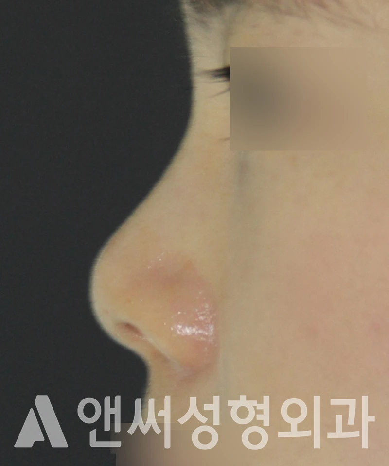 Answer Plastic Surgery case 545: Before