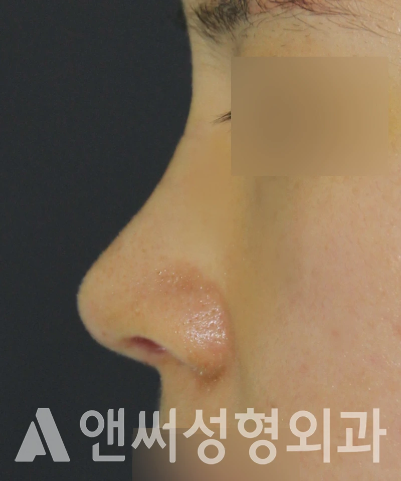 Answer Plastic Surgery case 545: After
