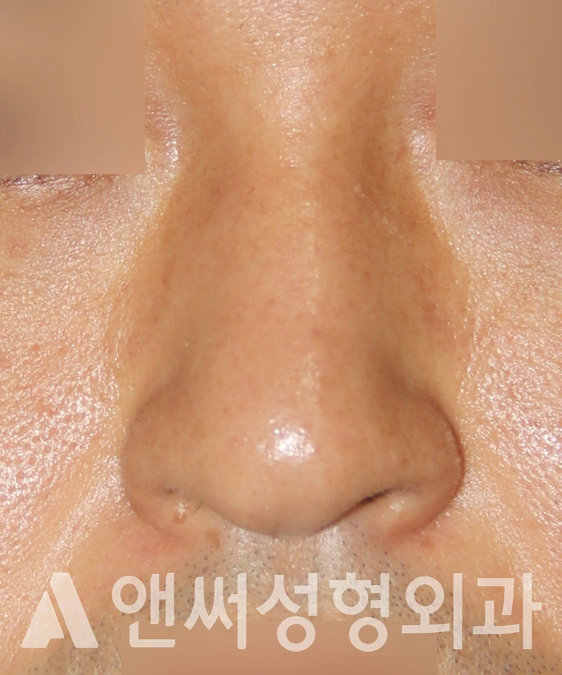 Answer Plastic Surgery case 544: Before
