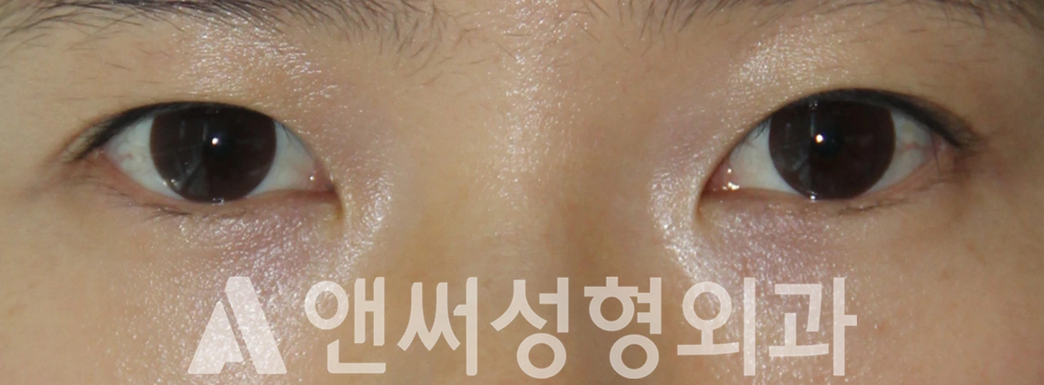 Answer Plastic Surgery case 542: Before