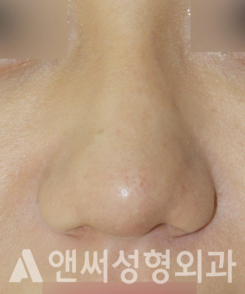 Answer Plastic Surgery case 541: Before