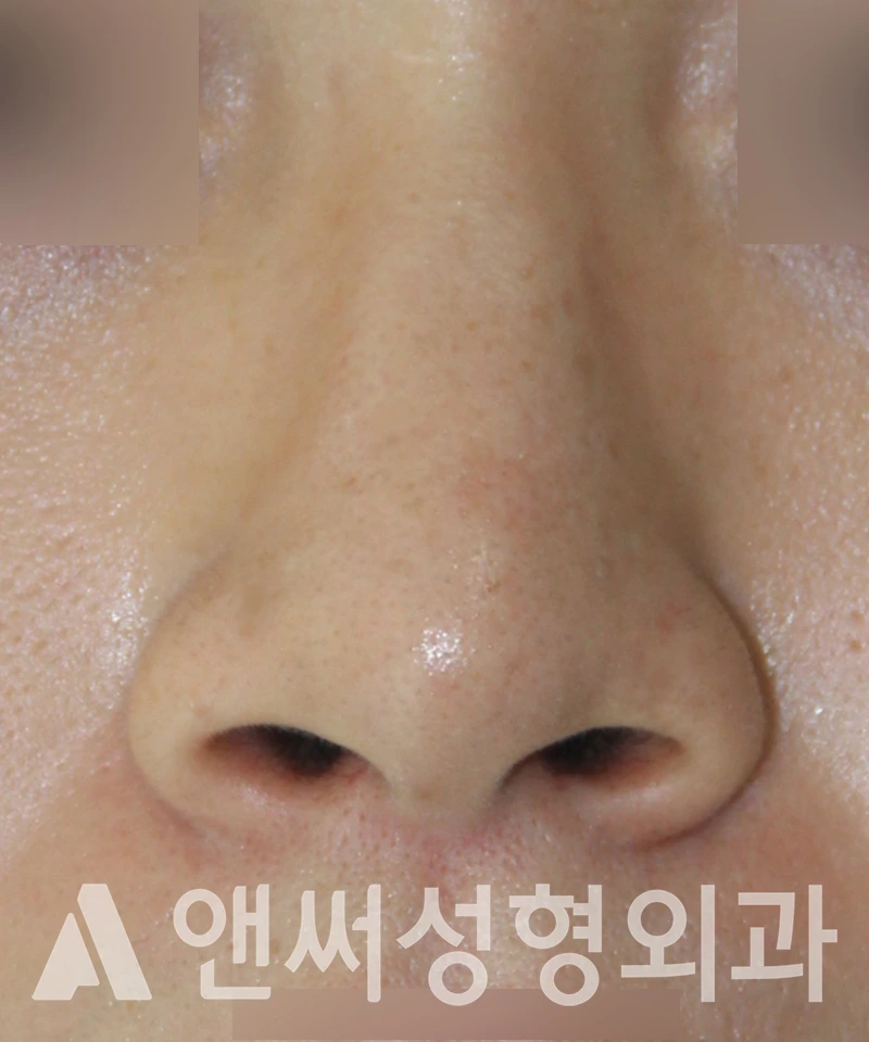 Answer Plastic Surgery case 538: Before