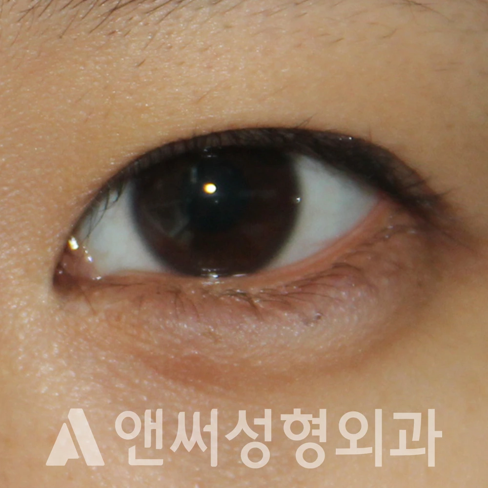 Answer Plastic Surgery case 536: Before