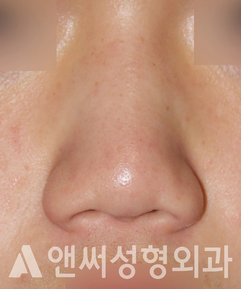 Answer Plastic Surgery case 535: Before