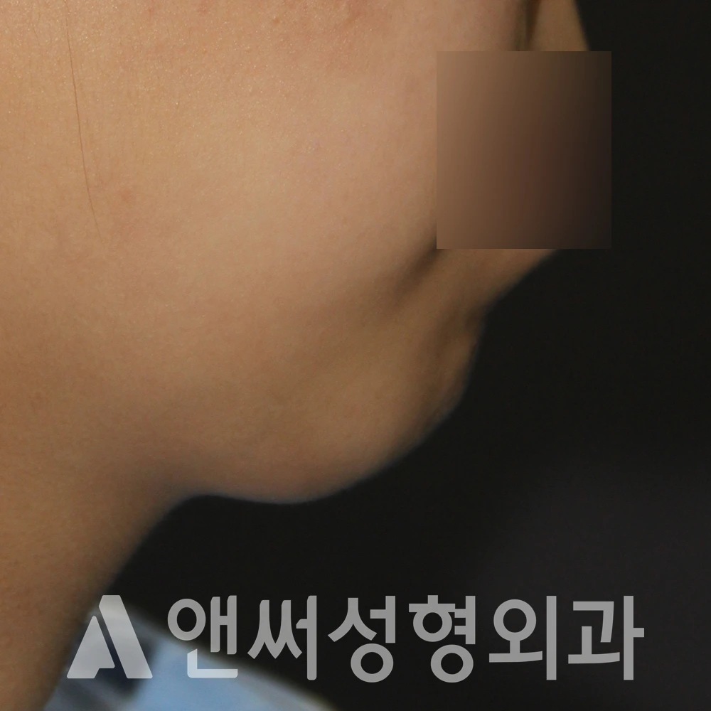 Answer Plastic Surgery case 533: Before