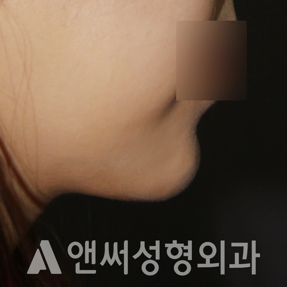 Answer Plastic Surgery case 533: After