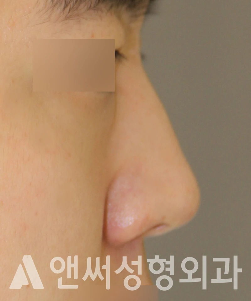 Answer Plastic Surgery case 532: Before