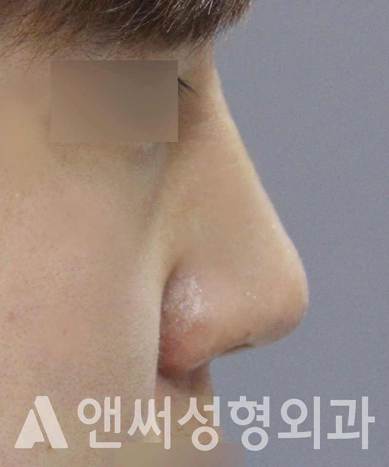 Answer Plastic Surgery case 532: After