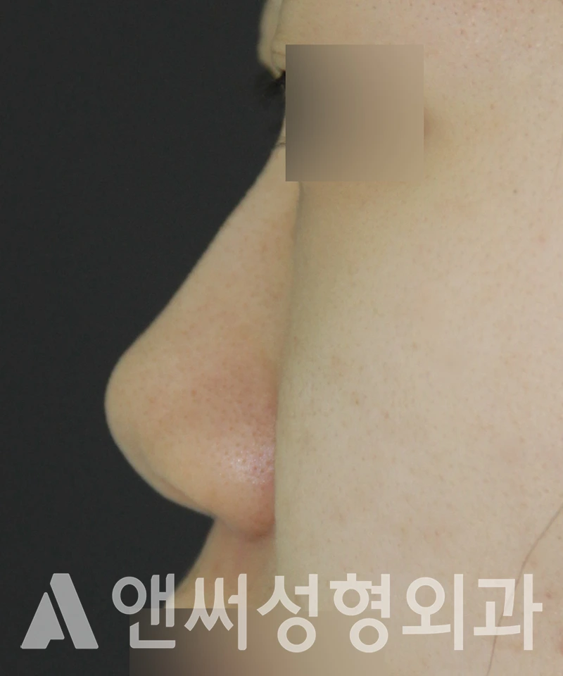 Answer Plastic Surgery case 531: Before