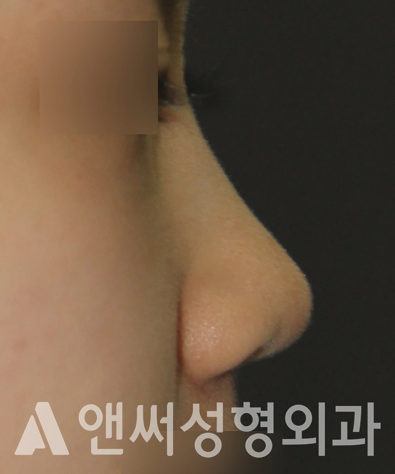 Answer Plastic Surgery case 530: Before