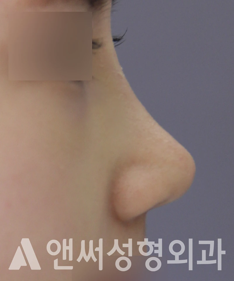 Answer Plastic Surgery case 530: After