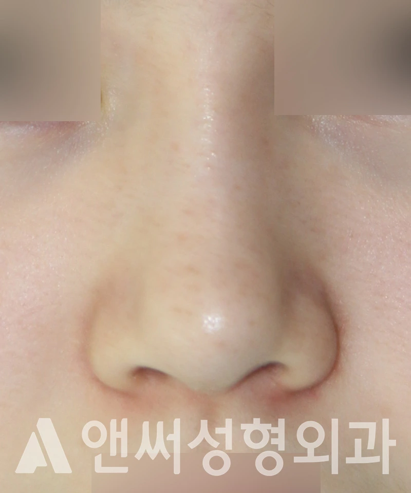Answer Plastic Surgery case 529: Before